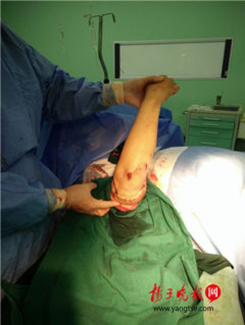 因车祸的严重撞击，丹阳印女士的右臂从上臂中间处完全离断。