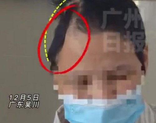 广东一女子突发车祸，头颅被“削”掉一半！十天后……奇迹存活